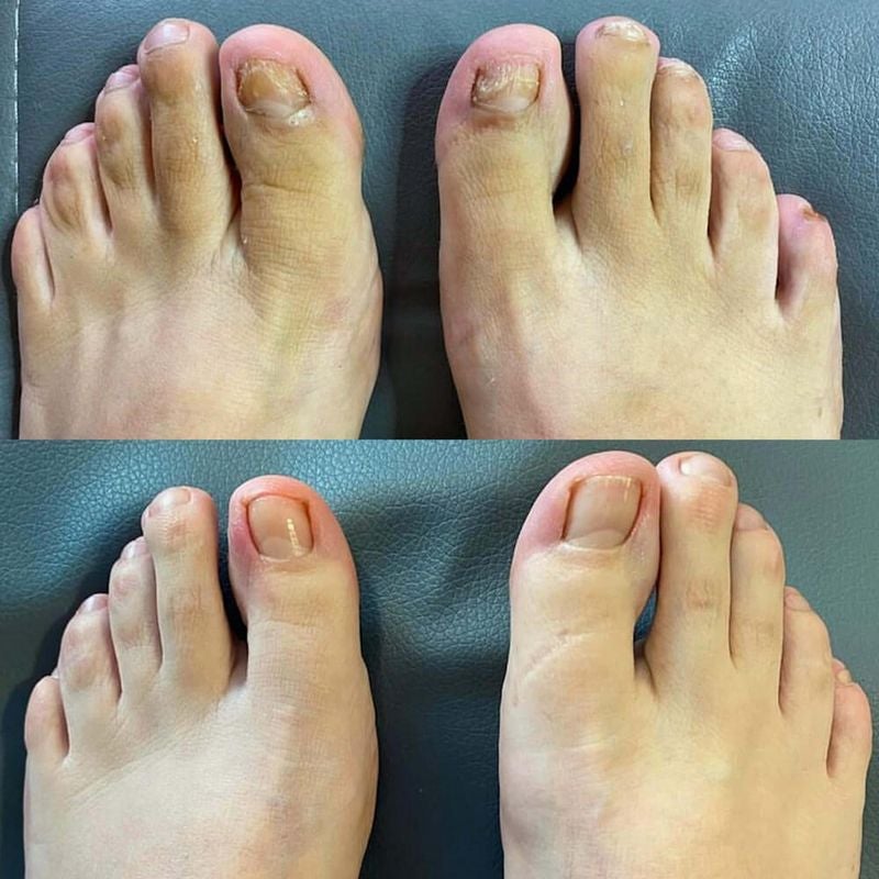 Big toenail appearance comparison
