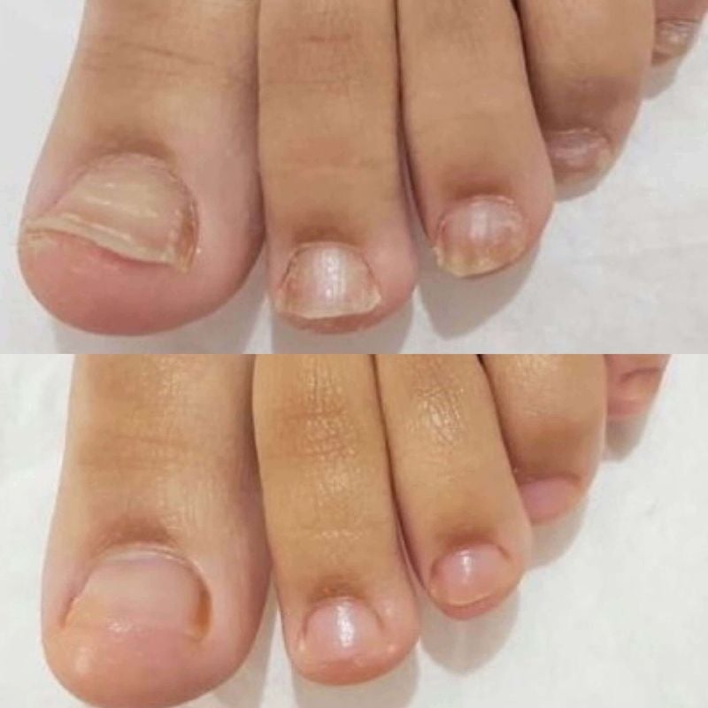 Damaged toenail comparison