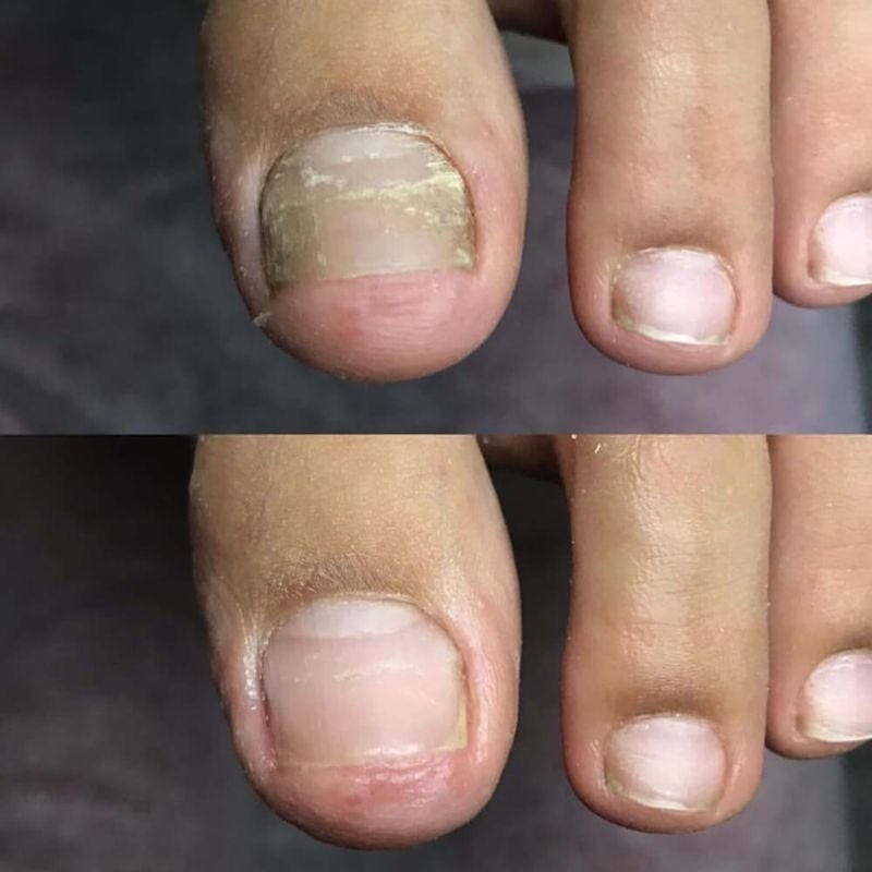 Thick toenail comparison