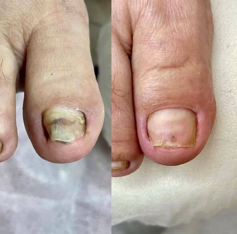 Toenail color comparison