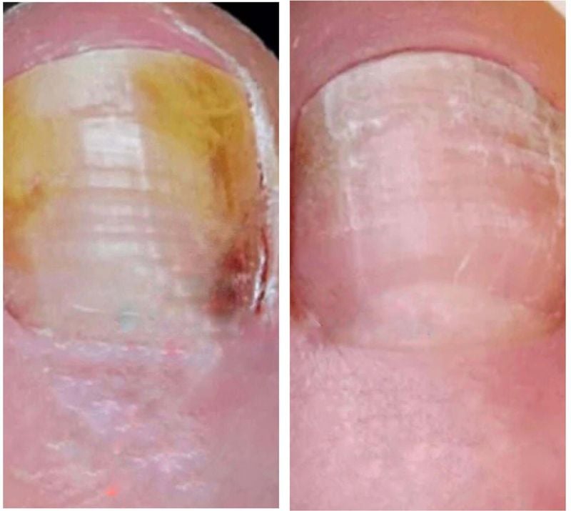Brittle toenail comparison