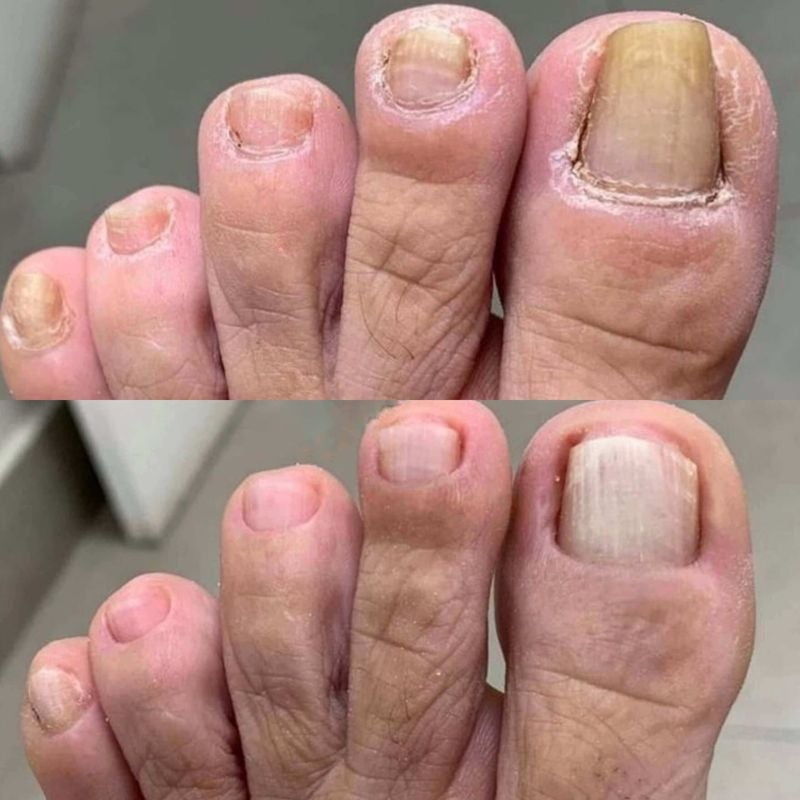 Discolored toenail comparison